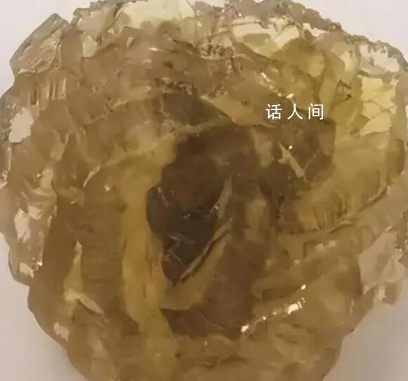 台州女子身体里取出了“花” 晶莹剔透酷似钻石形如玫瑰