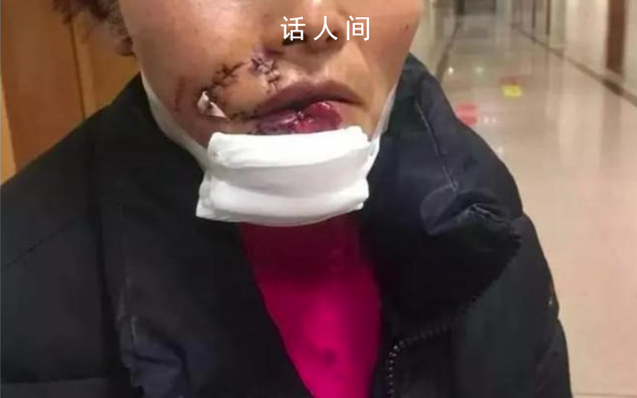女子被狗撕碎左脸缝了500多针 实在是太可怕了