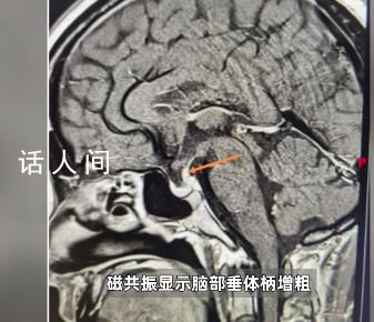 男子每天喝30斤水去50次厕所 连喝茶都是用盆来接