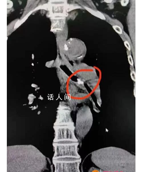 女子咳嗽20年竟因鸡骨头卡气管 将左支气管完全堵塞