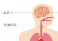 衣领综合征是什么梗 衣领综合征是什么意思